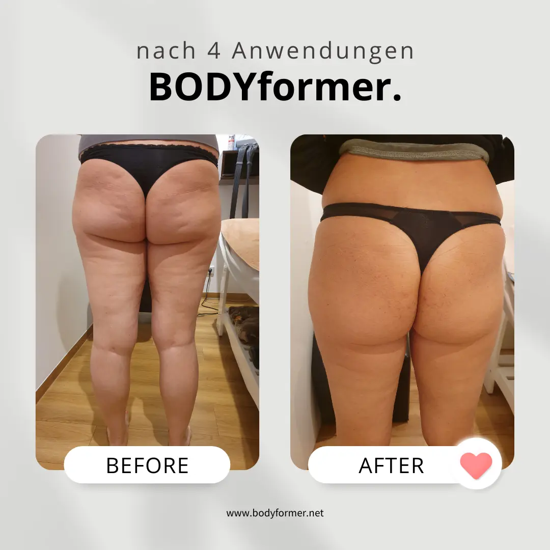 BODYformer vorher-nachher